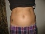 Before smart lipo - front